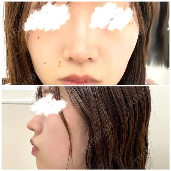 鼻尖形成（切開） / 小鼻縮小（切開） / 軟骨移植 / 鼻尖縮小 高崎美容クリニック DAY 64 メイン用
