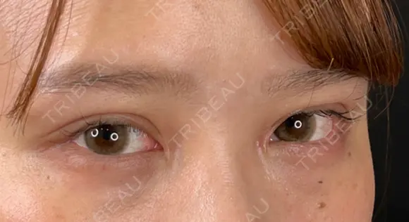 二重切開 / 目頭切開 藤・ナチュレ美容クリニック 恵比寿院 DAY 36 メイン用