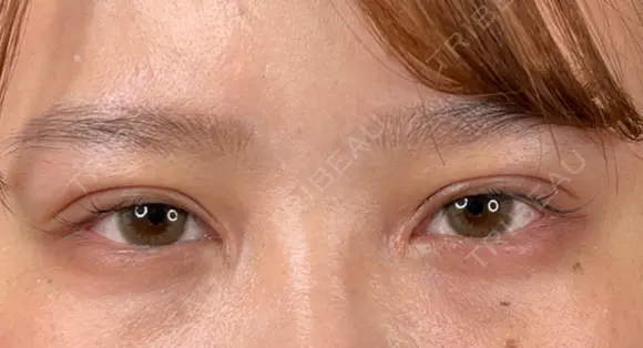 二重切開 / 目頭切開 藤・ナチュレ美容クリニック 恵比寿院 DAY 36 メイン用