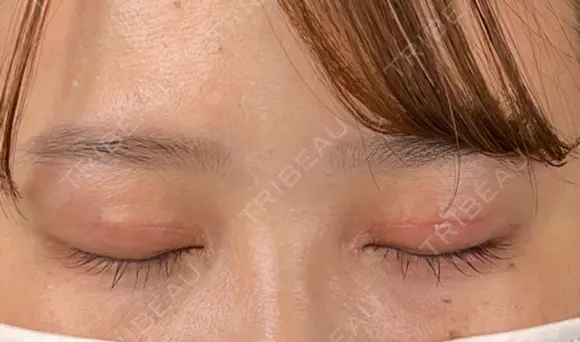 二重切開 / 目頭切開 藤・ナチュレ美容クリニック 恵比寿院 DAY 36 メイン用