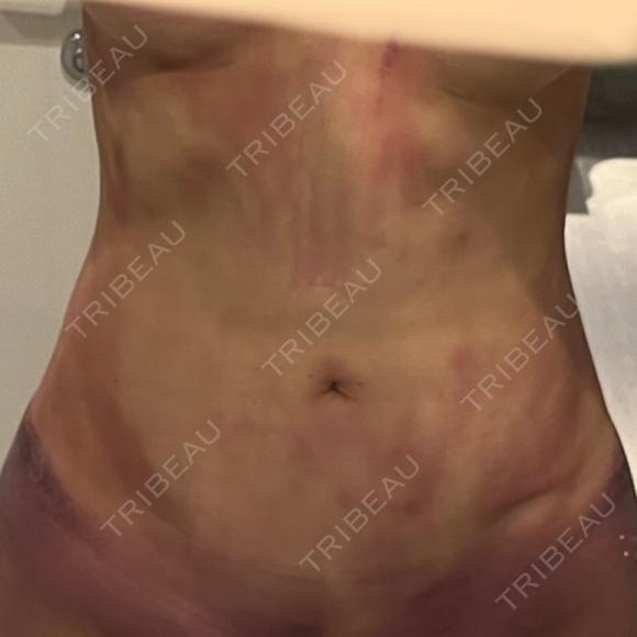脂肪吸引（お腹） / 脂肪吸引（腰） WOM CLINIC GINZA （ワム クリニック ギンザ） DAY 1 メイン用