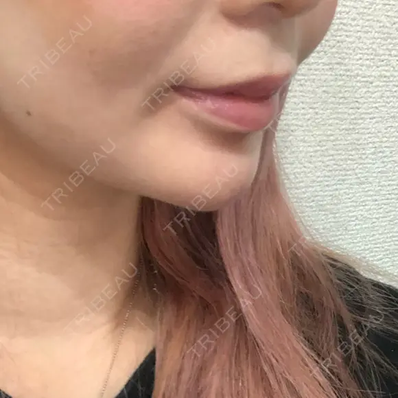 ボトックス（あご） / ヒアルロン酸注入（あご） KAGA CLINIC DAY 7 メイン用