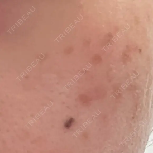 ピコスポット LOUIS CLINIC 二子玉川院【ルイクリニック】 DAY 17 メイン用