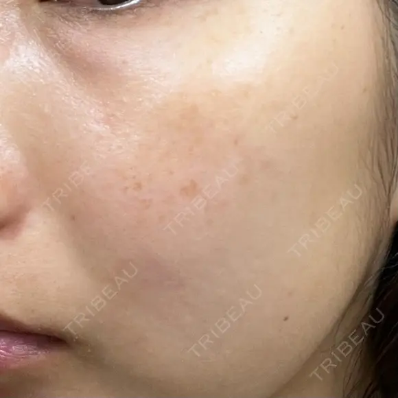 レーザートーニング（美白・肝斑） 渋谷美容外科クリニック 横浜院 DAY 0 メイン用