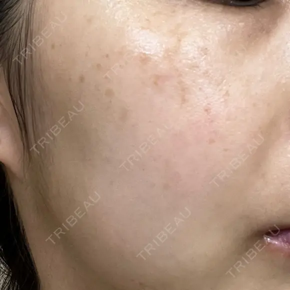 レーザートーニング（美白・肝斑） 渋谷美容外科クリニック 横浜院 DAY 10 メイン用