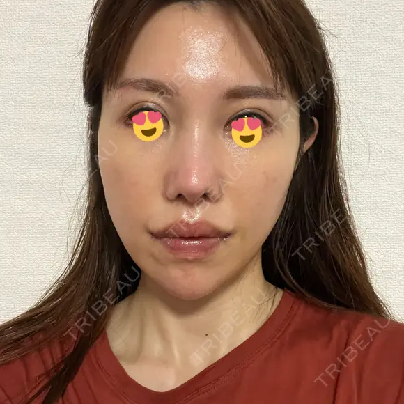 二重埋没 / 人中短縮 / 目尻切開 / 口角挙上 ヴェリテクリニック 名古屋院 DAY 8 メイン用