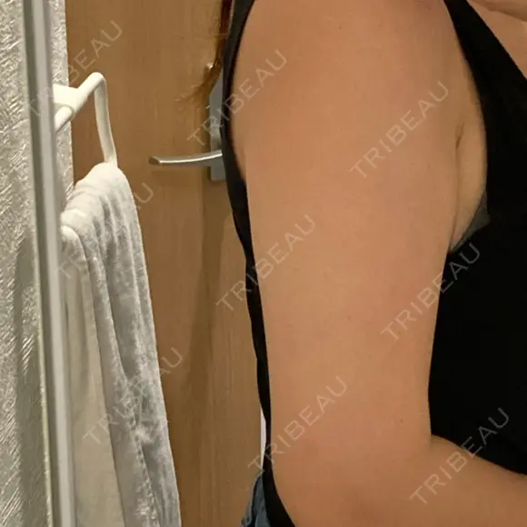 脂肪溶解注射（二の腕） 石倉クリニック 水戸院 AFTER メイン用