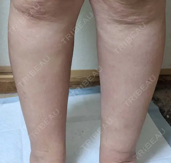 脂肪吸引（脚） アムルーズ美容外科クリニック 横浜院 DAY 56 メイン用