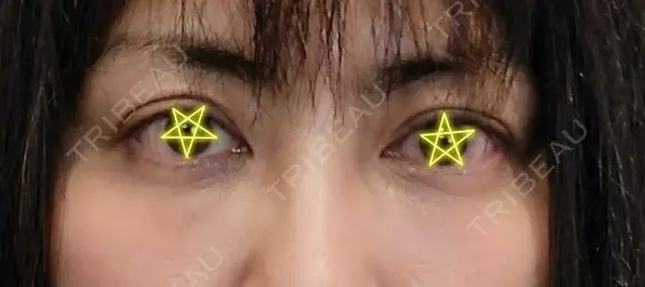 クマ治療 / 脂肪注入（目の下） あじまビューティークリニック DAY 15 メイン用