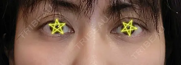 クマ治療 / 脂肪注入（目の下） あじまビューティークリニック AFTER メイン用