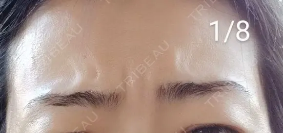 その他（肌） 湘南美容クリニック 宇都宮院 DAY 3 メイン用