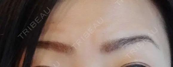 その他（肌） 湘南美容クリニック 宇都宮院 AFTER メイン用