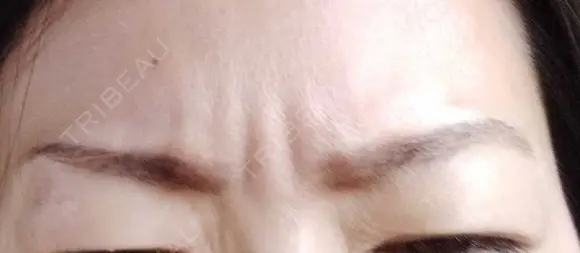 その他（肌） 湘南美容クリニック 宇都宮院 AFTER メイン用