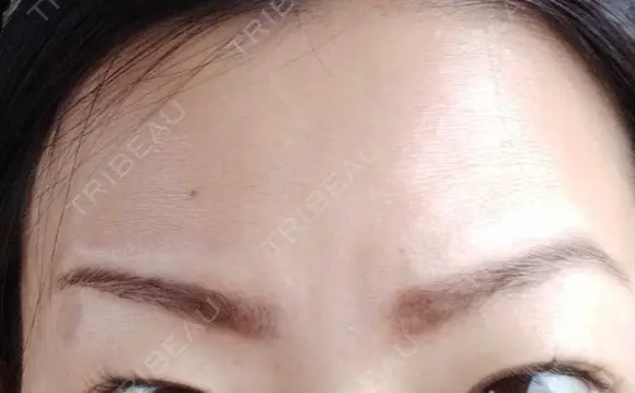 その他（肌） 湘南美容クリニック 宇都宮院 DAY 160 メイン用