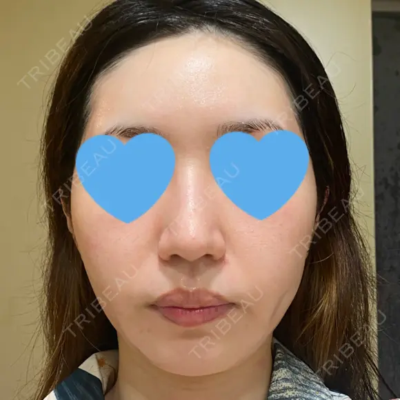 ピーリング（ニキビ・毛穴） / ピコフラクショナルレーザー（毛穴・ニキビ跡） CLINICA BellaForma DAY 4 メイン用