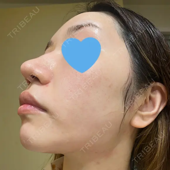 ピーリング（ニキビ・毛穴） / ピコフラクショナルレーザー（毛穴・ニキビ跡） CLINICA BellaForma DAY 4 メイン用