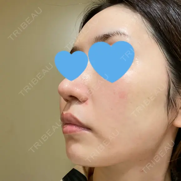 ピーリング（ニキビ・毛穴） / ピコフラクショナルレーザー（毛穴・ニキビ跡） CLINICA BellaForma DAY 5 メイン用