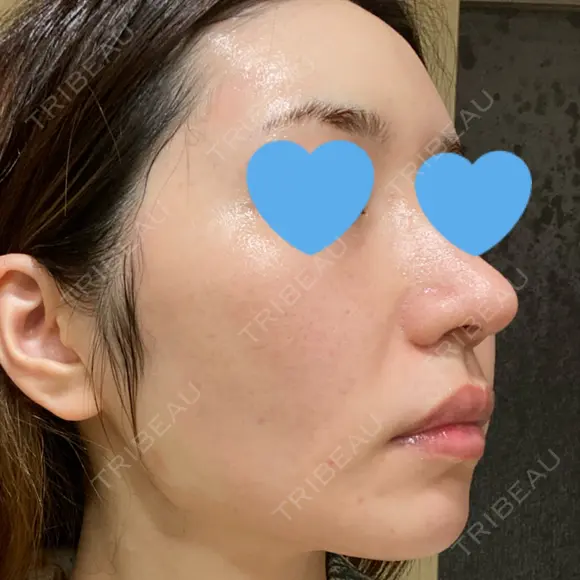 ピーリング（ニキビ・毛穴） / ピコフラクショナルレーザー（毛穴・ニキビ跡） CLINICA BellaForma DAY 5 メイン用