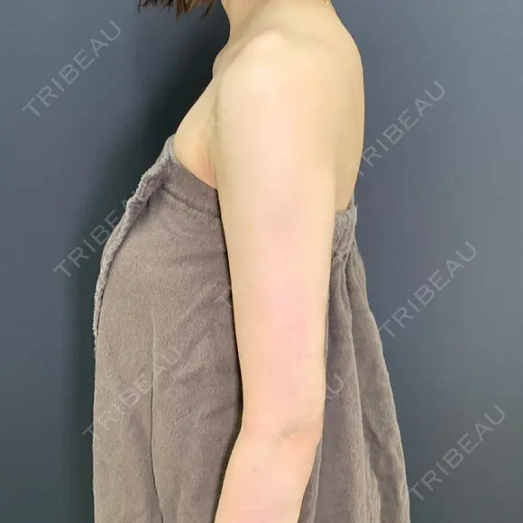 糸リフト / 脂肪吸引（顔） / 脂肪吸引（二の腕） / 脂肪吸引（肩） eクリニック 富山院 AFTER メイン用