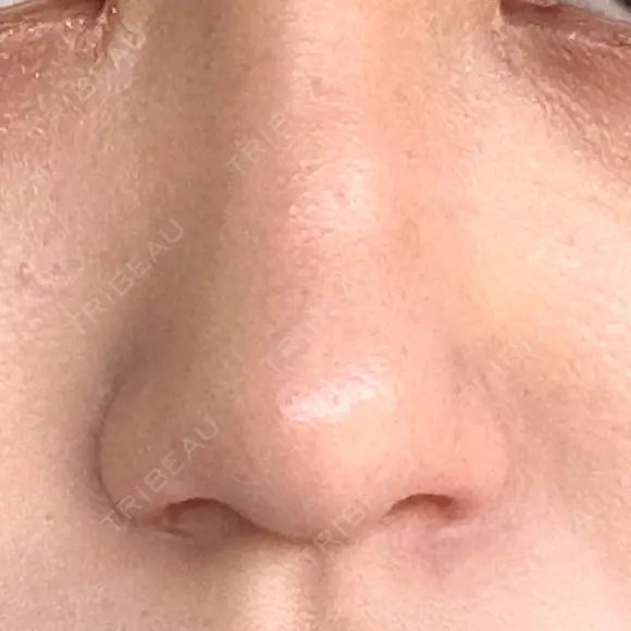 鼻孔縁挙上 GLANZ CLINIC AFTER メイン用