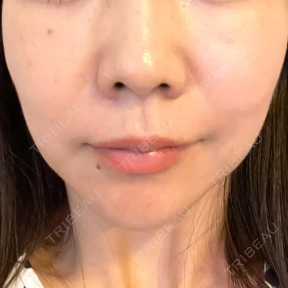 ハイフ（顔） TCB東京中央美容外科 岡山院 DAY 8 メイン用