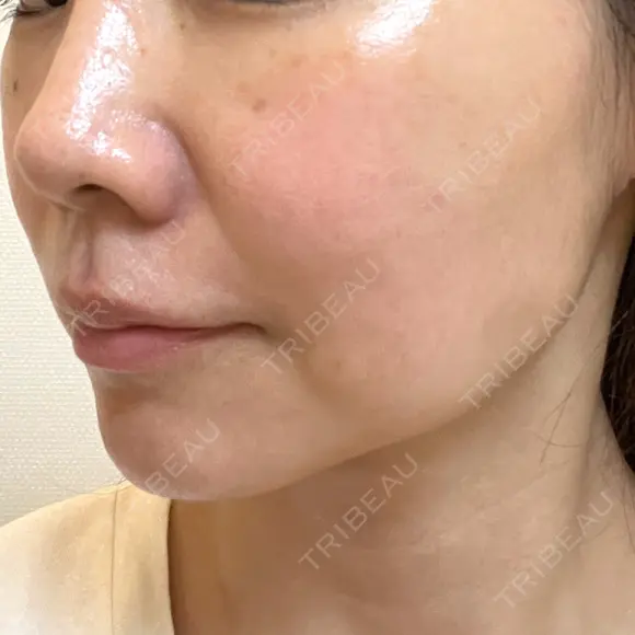 ハイフ（顔） TCB東京中央美容外科 岡山院 DAY 9 メイン用