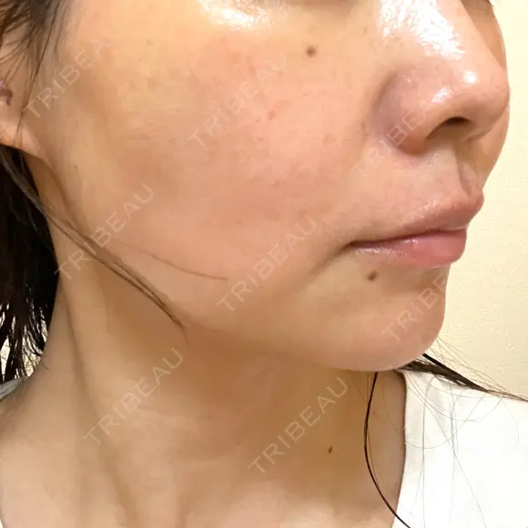 ハイフ（顔） TCB東京中央美容外科 岡山院 DAY 9 メイン用