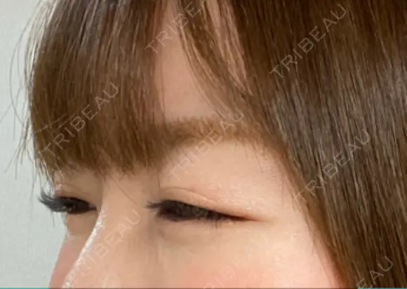 ボトックス（目尻） TCB東京中央美容外科 大宮東口院 DAY 13 メイン用