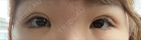 二重埋没 / クマ治療 NARU Beauty Clinic 【ナルクリ】 DAY 3 メイン用