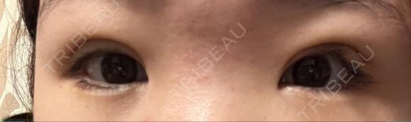 二重埋没 / クマ治療 NARU Beauty Clinic 【ナルクリ】 DAY 4 メイン用