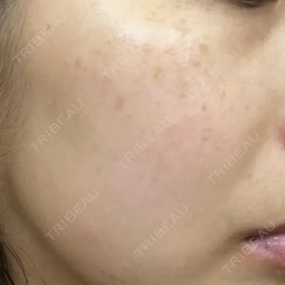 レーザートーニング（美白・肝斑） 渋谷美容外科クリニック 横浜院 AFTER メイン用