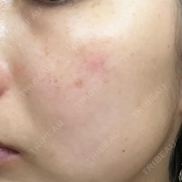 レーザートーニング（美白・肝斑） 渋谷美容外科クリニック 横浜院 DAY 20 メイン用