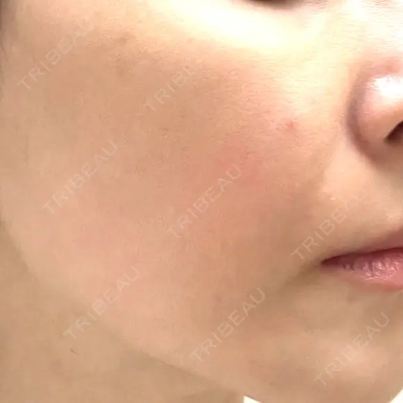 イオン導入 / ピコレーザートーニング（美白・肝斑） 湘南美容クリニック 静岡院 DAY 0 メイン用