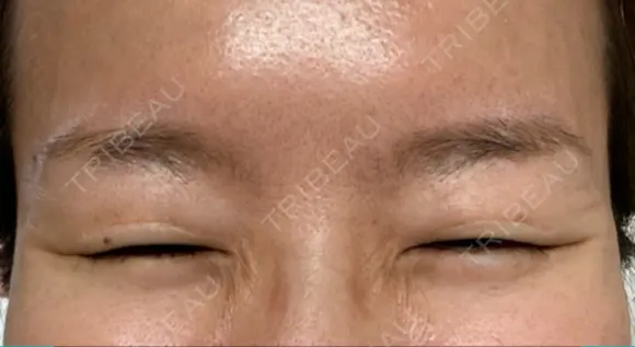 ボトックス（目尻） TCB東京中央美容外科 大宮東口院 DAY 15 メイン用