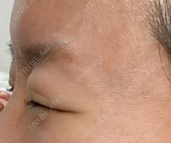 ボトックス（目尻） TCB東京中央美容外科 大宮東口院 DAY 15 メイン用