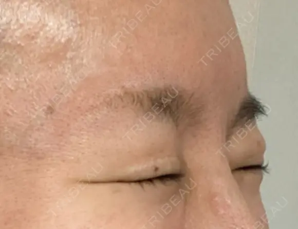 ボトックス（目尻） TCB東京中央美容外科 大宮東口院 DAY 15 メイン用