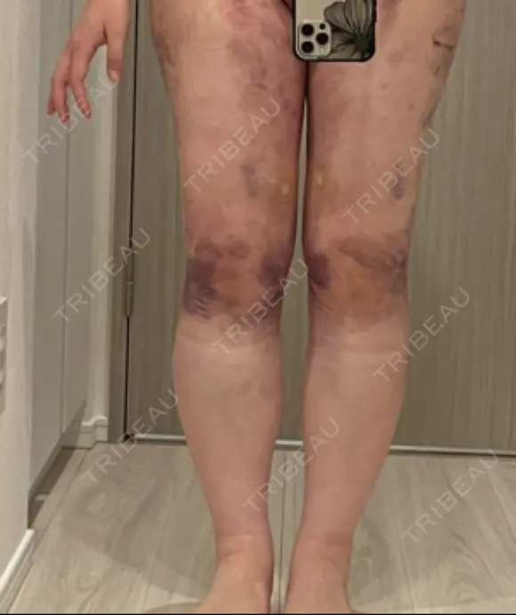 脂肪吸引（脚） 水の森美容クリニック 東京新宿院 DAY 2 メイン用