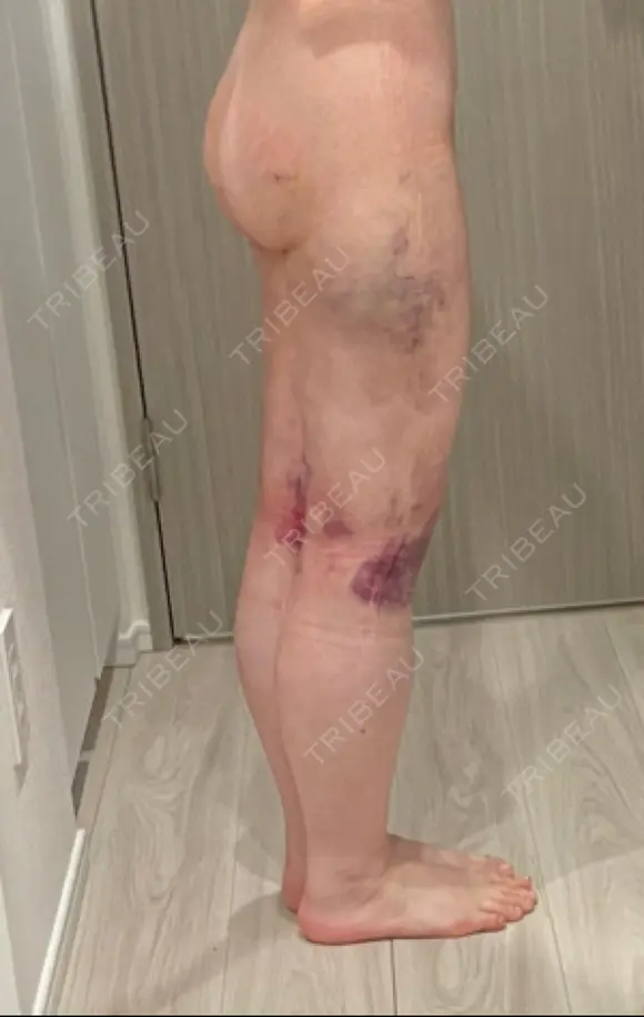 脂肪吸引（脚） 水の森美容クリニック 東京新宿院 DAY 2 メイン用