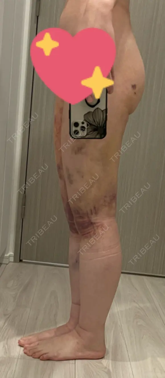 脂肪吸引（脚） 水の森美容クリニック 東京新宿院 DAY 5 メイン用