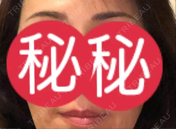 アートメイク（眉） / アートメイク（唇） APスキンクリニック銀座 AFTER メイン用