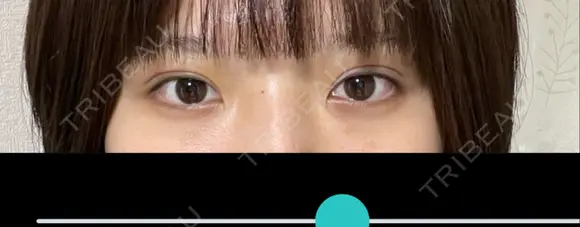 二重埋没 R.O.clinic DAY 5 メイン用