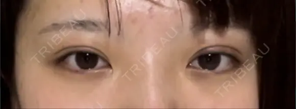 二重埋没 R.O.clinic DAY 8 メイン用
