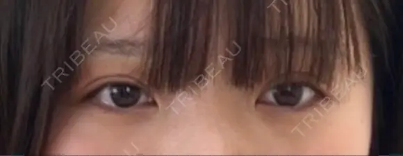 二重埋没 R.O.clinic DAY 19 メイン用