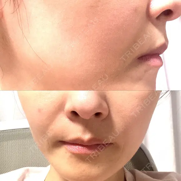 イオン導入 / ピコレーザートーニング（美白・肝斑） 湘南美容クリニック 静岡院 DAY 1 メイン用