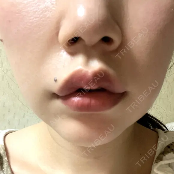 口角挙上 宇都宮竹内クリニック DAY 4 メイン用