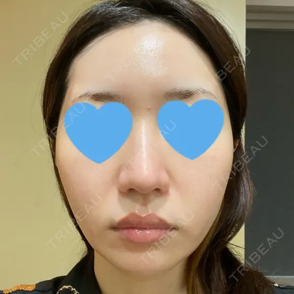 ピーリング（ニキビ・毛穴） / ピコフラクショナルレーザー（毛穴・ニキビ跡） CLINICA BellaForma AFTER メイン用