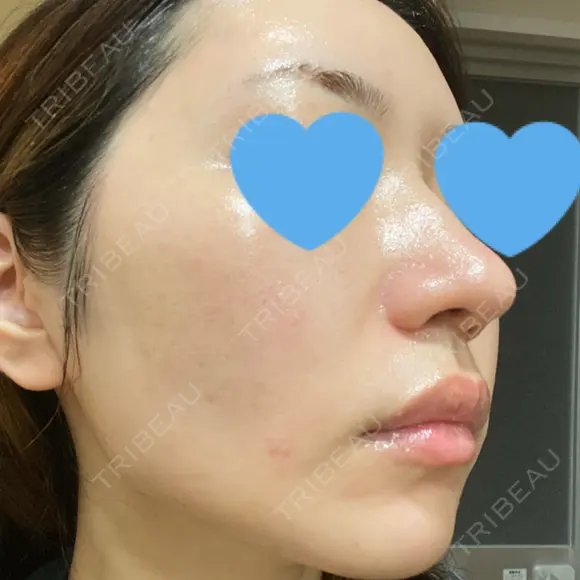 ピーリング（ニキビ・毛穴） / ピコフラクショナルレーザー（毛穴・ニキビ跡） CLINICA BellaForma DAY 11 メイン用