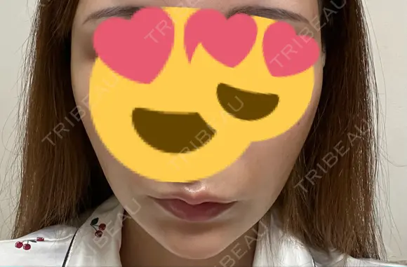ヒアルロン酸注入（あご） / ヒアルロン酸注入（こめかみ） 大阪消化器内科・内視鏡クリニック難波院 AFTER メイン用