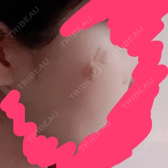 ほくろ・いぼ切除（肌） ニューセンス皮膚科クリニック AFTER メイン用