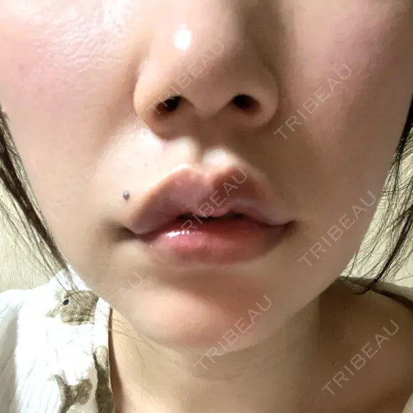口角挙上 宇都宮竹内クリニック DAY 5 メイン用